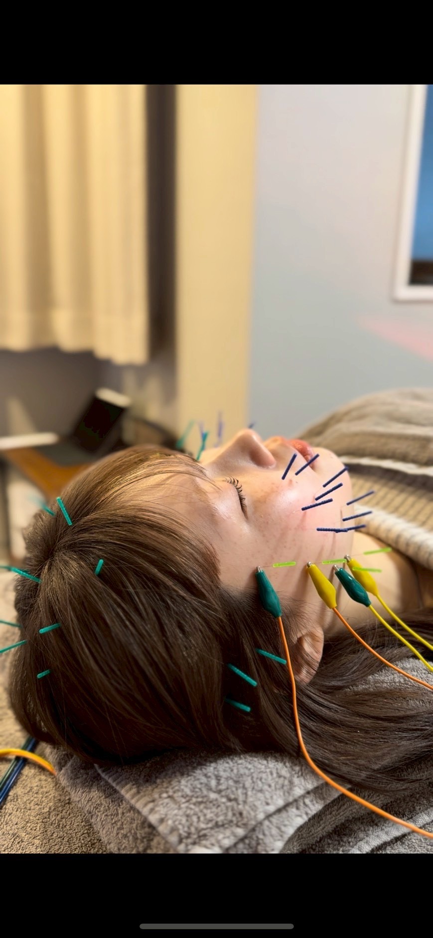 整体・鍼 ／ 小顔美容鍼 2